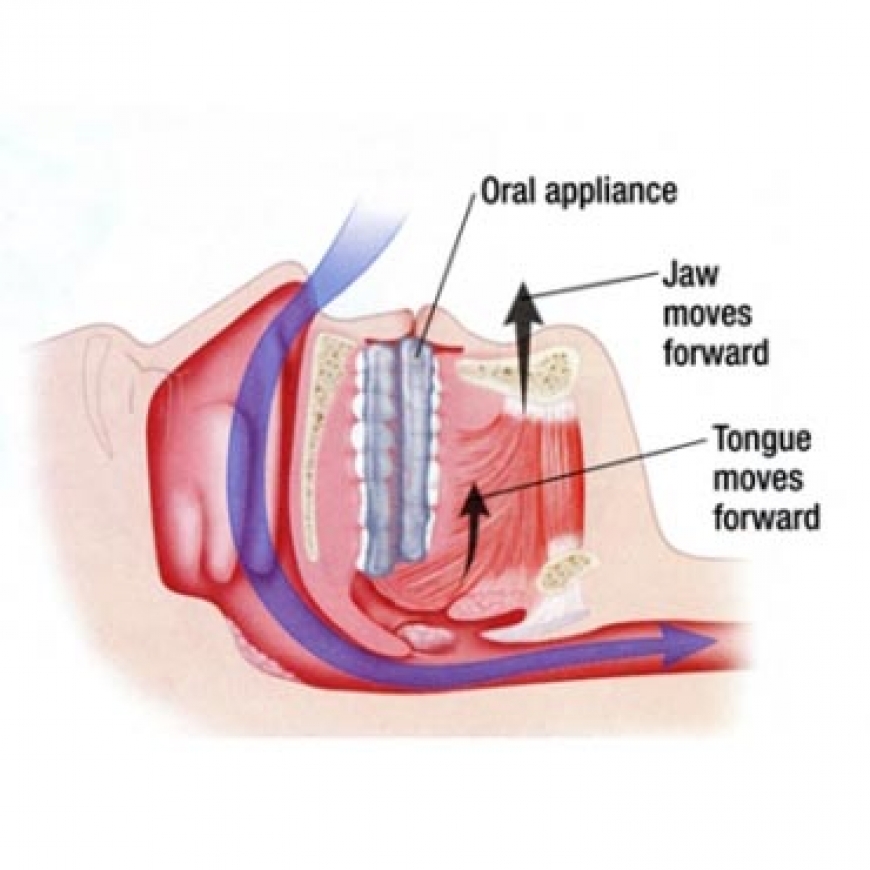 دستگاه داخل دهانی
